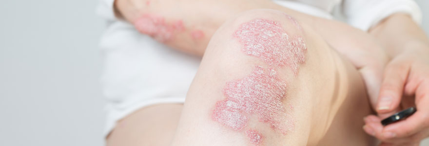 psoriasis